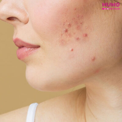 মুখের দাগ দূর করার প্রাকৃতিক ফেস প্যাক